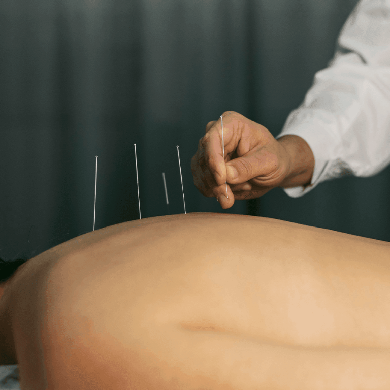 Ankara akapunktur tedavisi