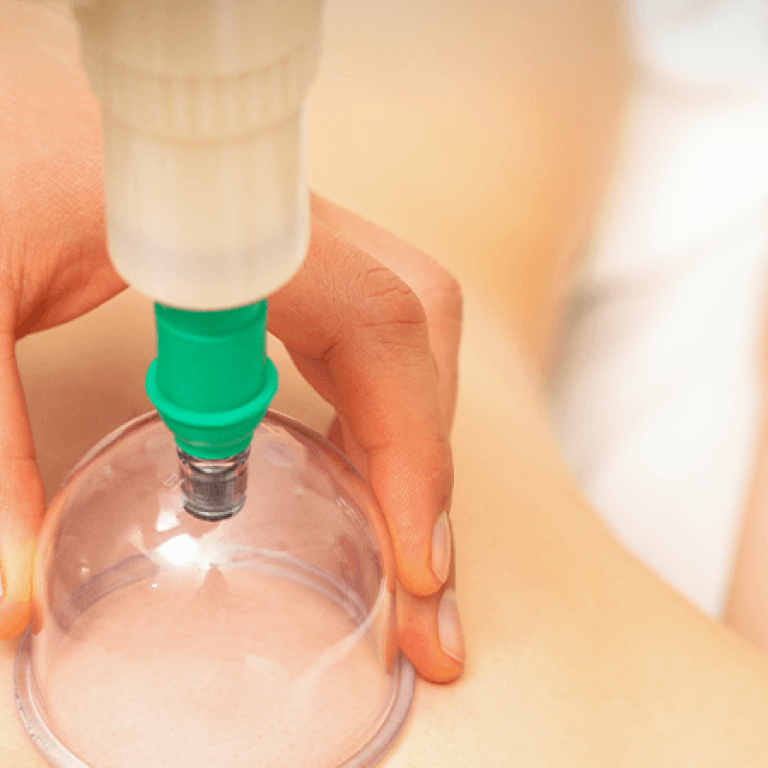 Ankara hacamat tedavisi