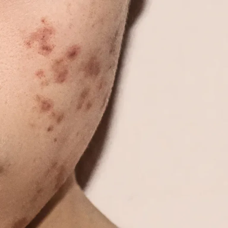 leke-mezoterapisi-kac-seans-surer